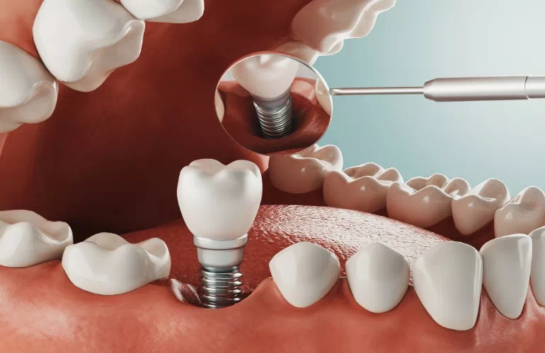 model implantu zęba